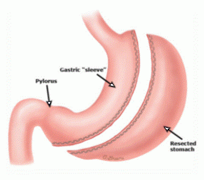 Sleeve Gastrectomy-dr Marco Franceschin